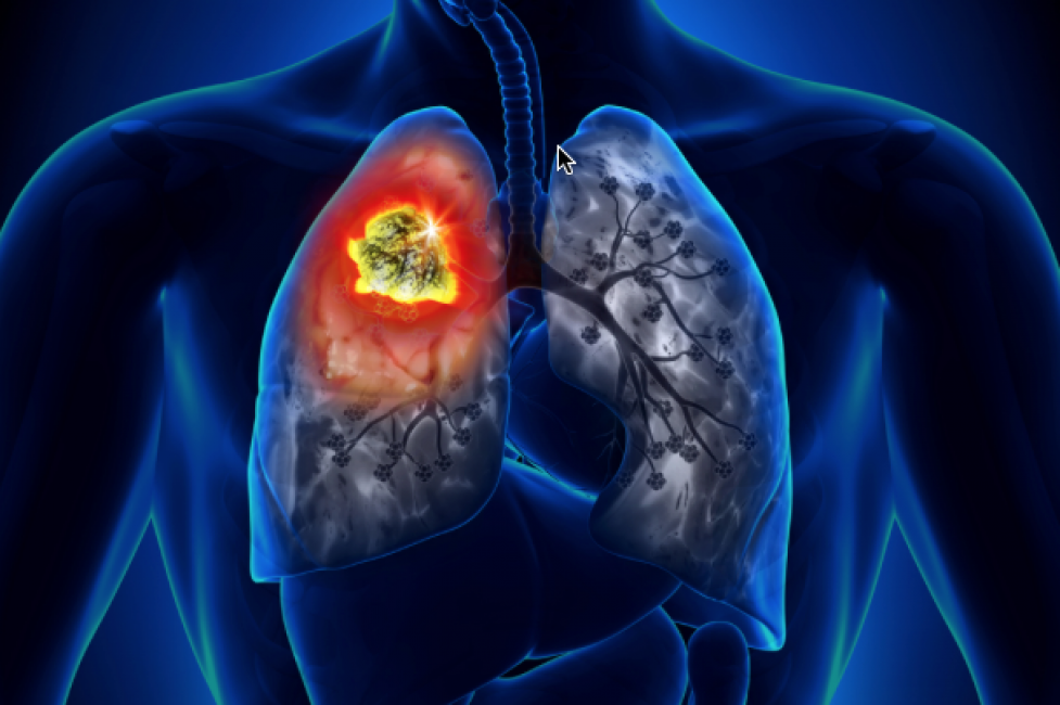 Immunoterapia e neoplasie polmonari – Corso RES-Videoconferenza 27 Maggio 2021
