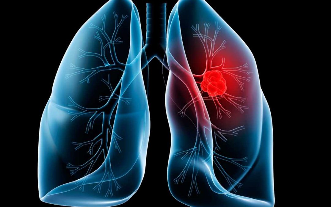 Immunoncologia nel trattamento del carcinoma polmonare Esperienze di pratica clinica a confronto – Preganziol (TV) 11 Aprile 2022